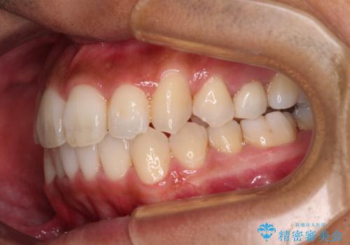 【モニター】左右のクロスバイトをインビザラインできれいに改善の治療後