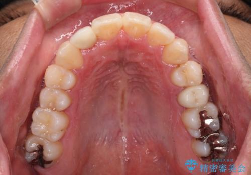 【モニター】左右のクロスバイトをインビザラインできれいに改善の治療後