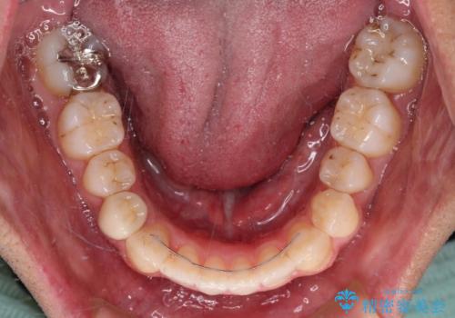 【モニター】左右のクロスバイトをインビザラインできれいに改善の治療後