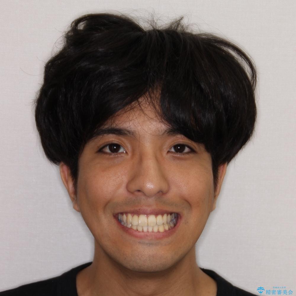 【モニター】左右のクロスバイトをインビザラインできれいに改善の治療後(顔貌)