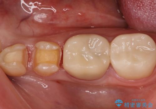 矯正終了し、かけたところをセラミックにて治したい。の治療中