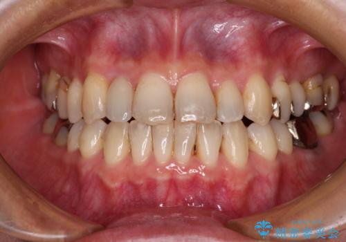 急速拡大装置　前歯の反対咬合をインビザラインで改善の症例 治療後