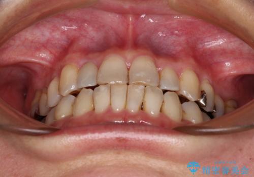 急速拡大装置 前歯の反対咬合をインビザラインで改善の治療後