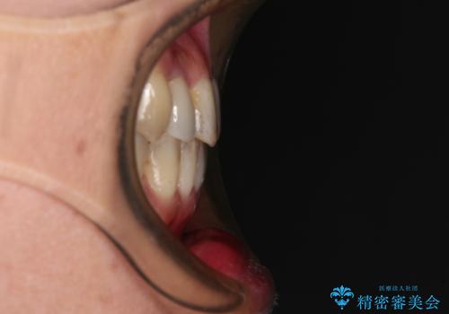急速拡大装置　前歯の反対咬合をインビザラインで改善の治療後