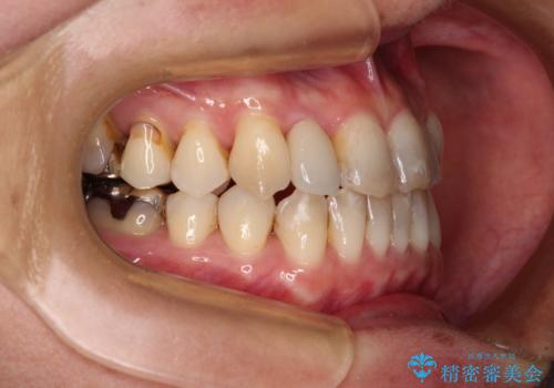 急速拡大装置 前歯の反対咬合をインビザラインで改善の治療後
