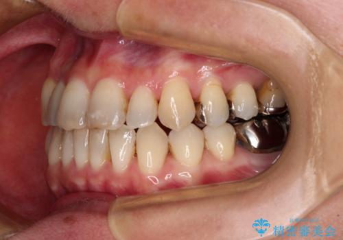 急速拡大装置 前歯の反対咬合をインビザラインで改善の治療後