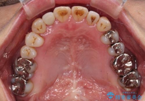 急速拡大装置 前歯の反対咬合をインビザラインで改善の治療後