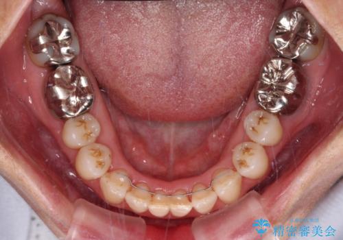 急速拡大装置 前歯の反対咬合をインビザラインで改善の治療後