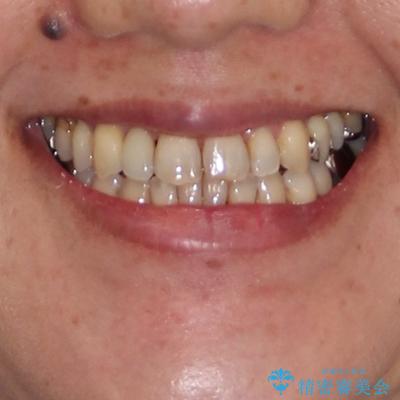 急速拡大装置　前歯の反対咬合をインビザラインで改善の治療後（顔貌）