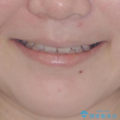 目立たない裏側矯正で突出感を改善 ハーフリンガル矯正の治療後(顔貌)