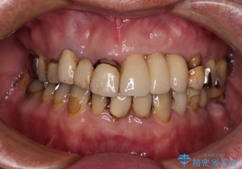 転倒で折れてしまった前歯 インプラントによるオールセラミックブリッジ治療の治療後