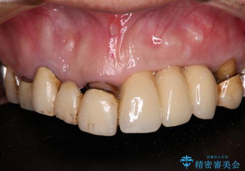 転倒で折れてしまった前歯 インプラントによるオールセラミックブリッジ治療