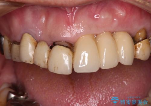 転倒で折れてしまった前歯 インプラントによるオールセラミックブリッジ治療の治療後