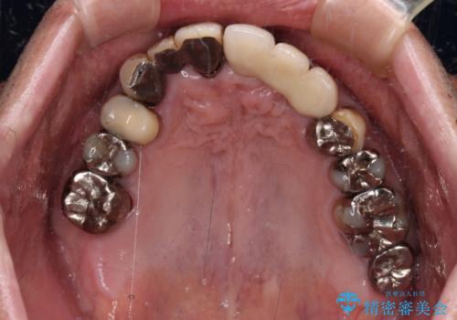 転倒で折れてしまった前歯 インプラントによるオールセラミックブリッジ治療の治療後