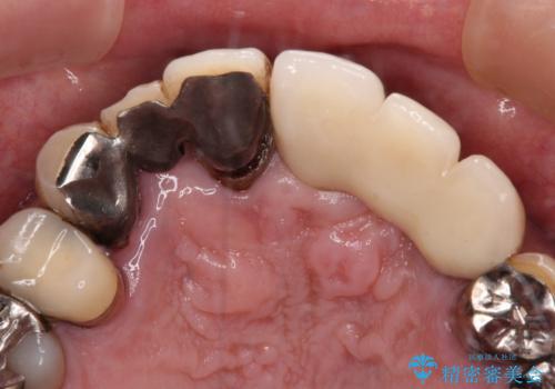 転倒で折れてしまった前歯 インプラントによるオールセラミックブリッジ治療の治療後