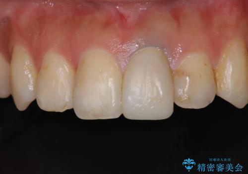 矯正治療が終了し、前歯を治したいの症例 治療前