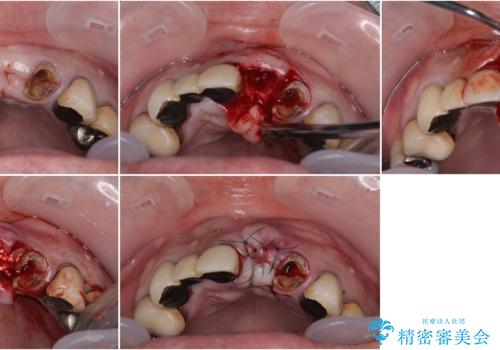 転倒で折れてしまった前歯 インプラントによるオールセラミックブリッジ治療の治療中