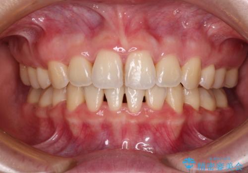 【モニター】短期間で口の閉じにくさを改善　ワイヤー装置での抜歯矯正の症例 治療後