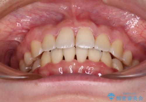 【モニター】短期間で口の閉じにくさを改善 ワイヤー装置での抜歯矯正の治療後