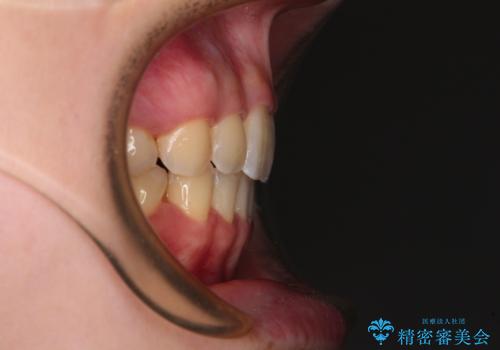 【モニター】短期間で口の閉じにくさを改善 ワイヤー装置での抜歯矯正の治療後