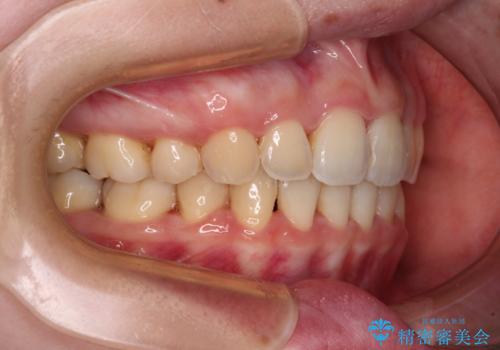 【モニター】短期間で口の閉じにくさを改善 ワイヤー装置での抜歯矯正の治療後