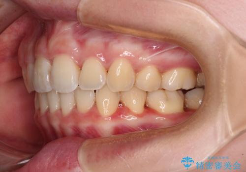 【モニター】短期間で口の閉じにくさを改善　ワイヤー装置での抜歯矯正の治療後