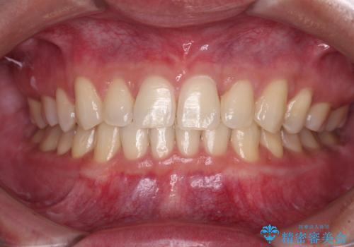 空隙歯列弓(すきっ歯)の症例 治療後