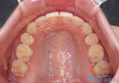 【モニター】短期間で口の閉じにくさを改善 ワイヤー装置での抜歯矯正の治療後
