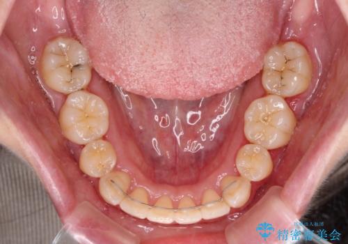 【モニター】短期間で口の閉じにくさを改善　ワイヤー装置での抜歯矯正の治療後