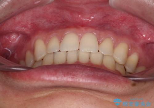 著しいディープバイトと隙間だらけの歯列 の治療後