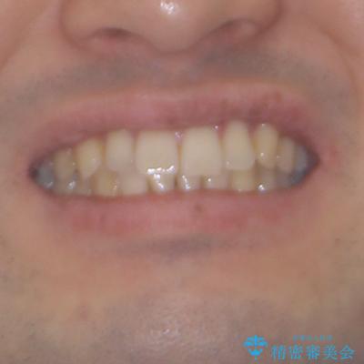 ワイヤー装置での上下前歯の部分矯正の治療前（顔貌）