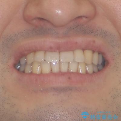 ワイヤー装置での上下前歯の部分矯正の治療後（顔貌）