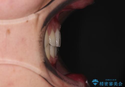 著しいディープバイトと隙間だらけの歯列 の治療後