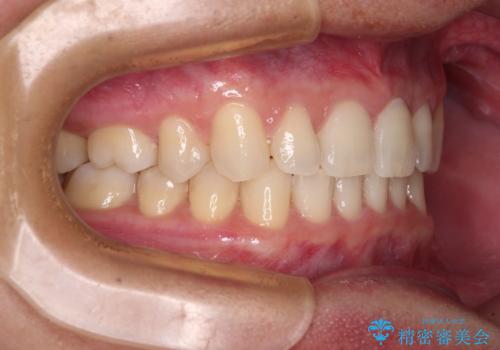 著しいディープバイトと隙間だらけの歯列 の治療後