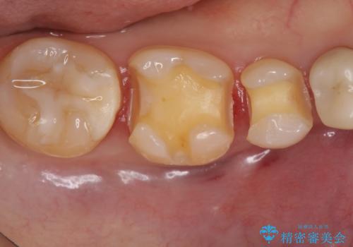 下の歯の銀歯が目立つの治療中