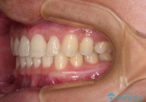 著しいディープバイトと隙間だらけの歯列 の治療後