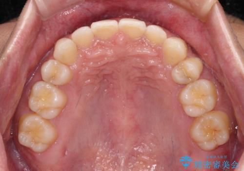 著しいディープバイトと隙間だらけの歯列 の治療後