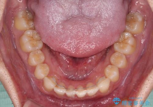 著しいディープバイトと隙間だらけの歯列 の治療後