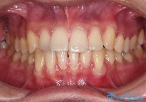 ワイヤー装置での上下前歯の部分矯正の症例 治療前