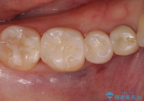 下の歯の銀歯が目立つの症例 治療後