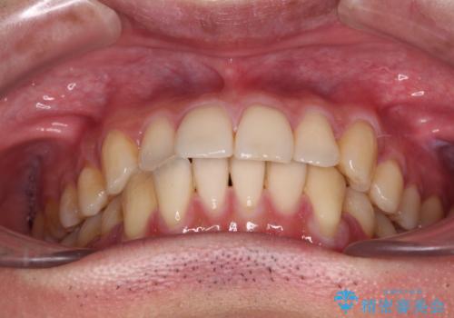 ワイヤー装置での上下前歯の部分矯正の治療前