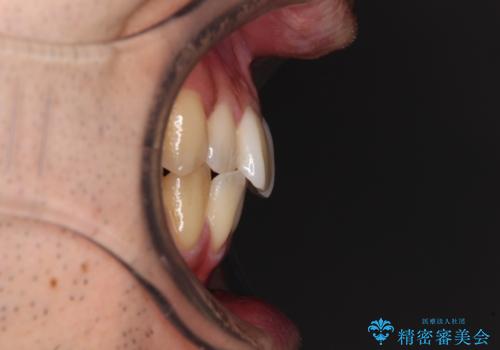 ワイヤー装置での上下前歯の部分矯正の治療前