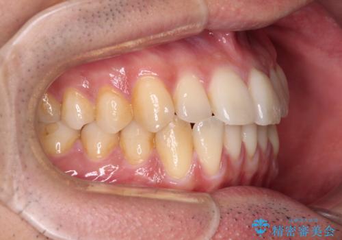 ワイヤー装置での上下前歯の部分矯正の治療前