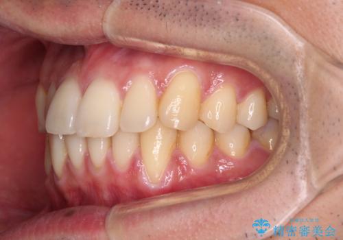 ワイヤー装置での上下前歯の部分矯正の治療前