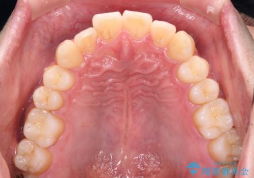ワイヤー装置での上下前歯の部分矯正の治療前