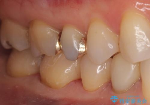 下の歯の銀歯が目立つの治療後