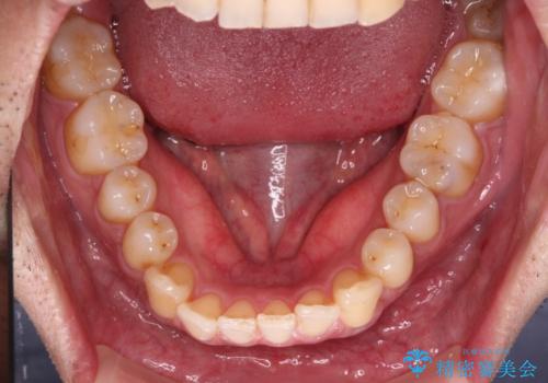 ワイヤー装置での上下前歯の部分矯正の治療前