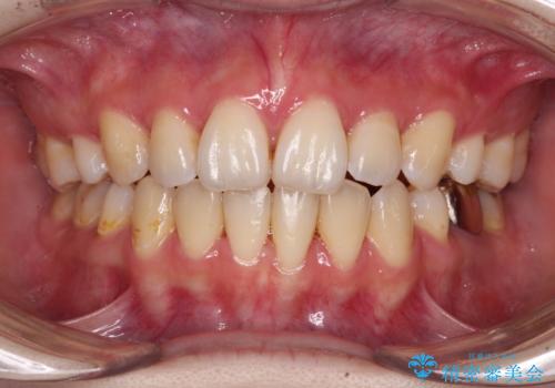 目立たない裏側矯正で突出感を改善 ハーフリンガル矯正