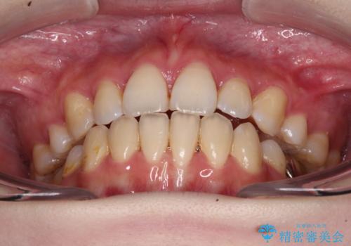 目立たない裏側矯正で突出感を改善 ハーフリンガル矯正の治療後
