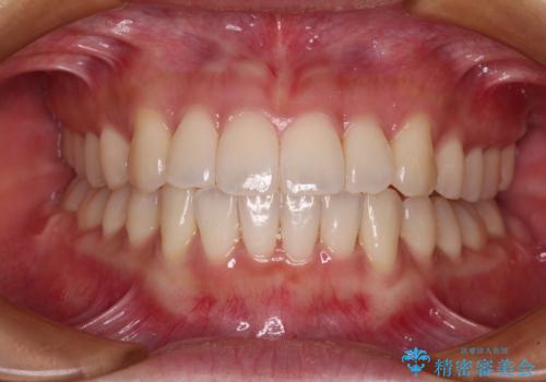 捻れた前歯をできるだけ短期間で　表側のワイヤー矯正の症例 治療後